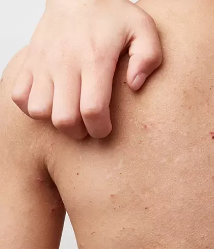 Homeopathic solutions for Skin Disorders